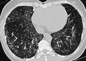 Alveolar Proteinosis – HRCT